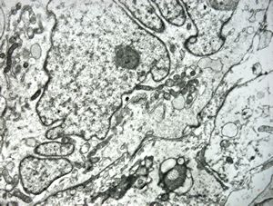 F,12y. | malignant tumor of the orbita - liposarcoma?, neurofibrosarcoma? F,12y. | malignant tumor of the orbita - liposarcoma?, neurofibrosarcoma?